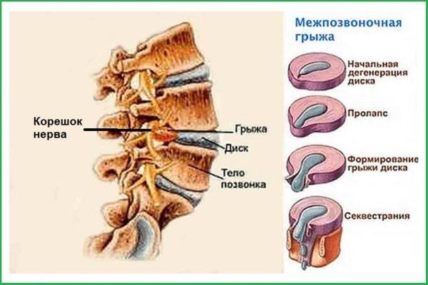 Можно ли получить больничный у невролога после посещения терапевта?